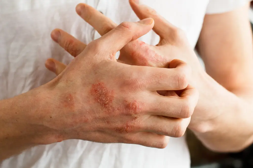 Understanding Eczema Blisters: Symptoms, Causes, and Treatment Options